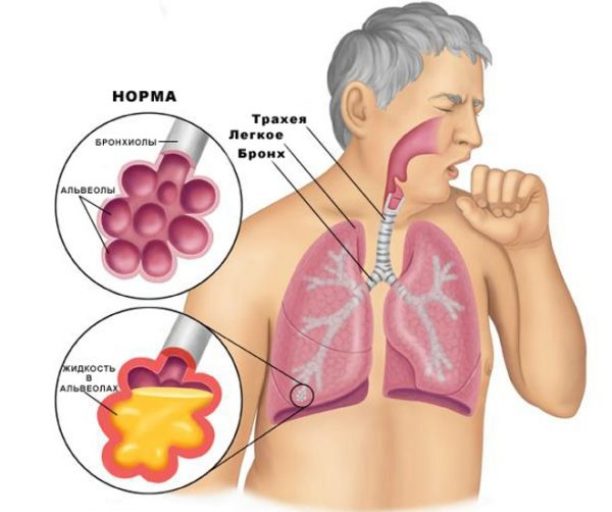 Особенности застойной пневмонии у пожилых людей